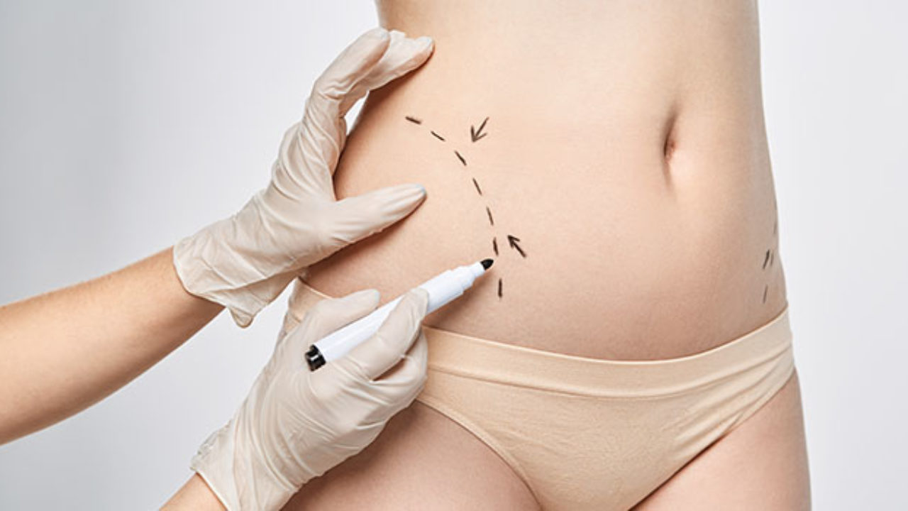 Knowing Liposuction Melbourne post thumbnail image
