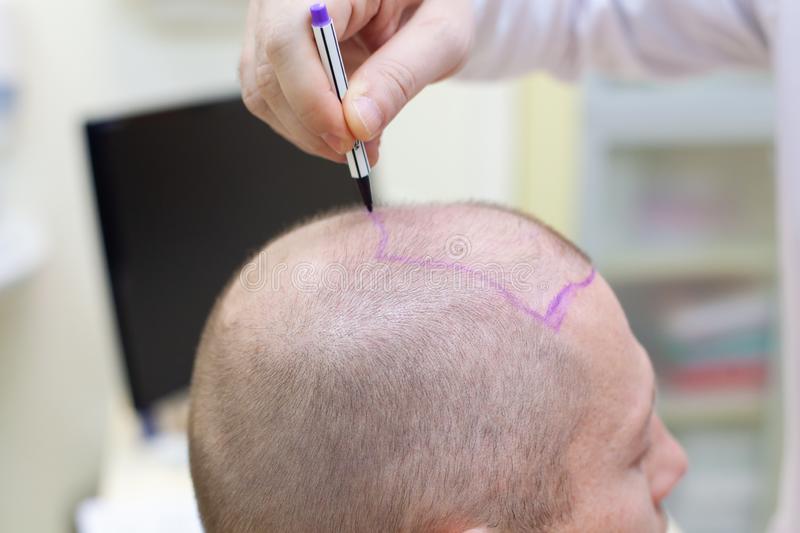 How to experience benefits from a hair transplant surgery? post thumbnail image